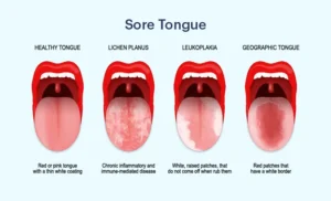 oral health sore tounge