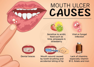 Oral Ulcer